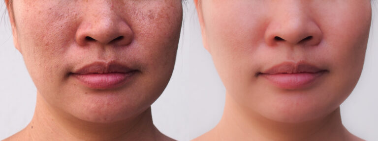 Before and after results of sun damage treatment at a med spa in Tampa