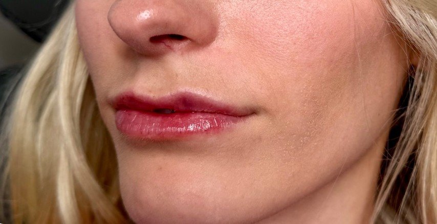 After Dermal Filler
