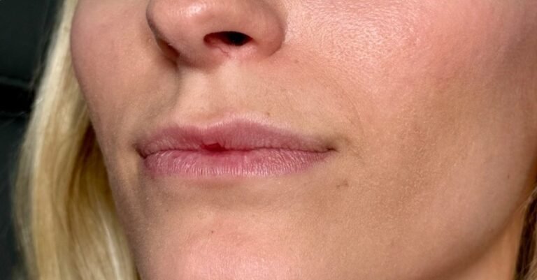 Before Dermal Filler