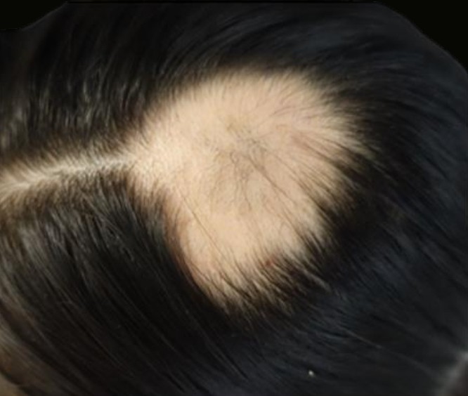 Hair Resto Before