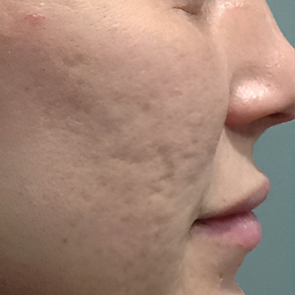 Microneedling — Before
