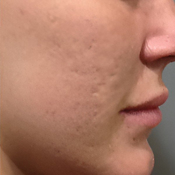 Microneedling — After
