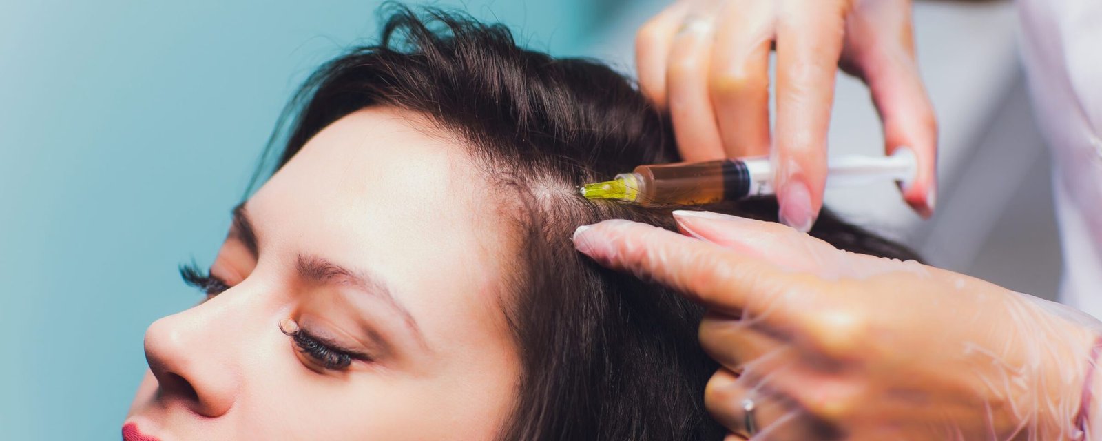 Platelet rich plasma injection procedure. Hair growth stimulation. PRP therapy process