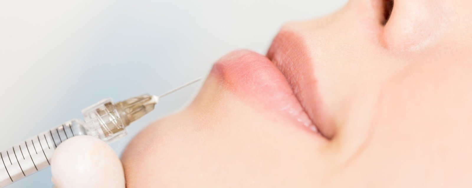Closeup of dermal fillers being injected in lips and around the mouth to get full lips