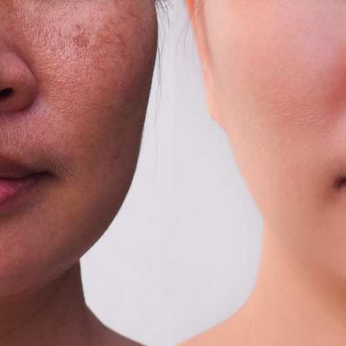 How Med Spa Treatments in Tampa Can Help Reverse Sun Damage