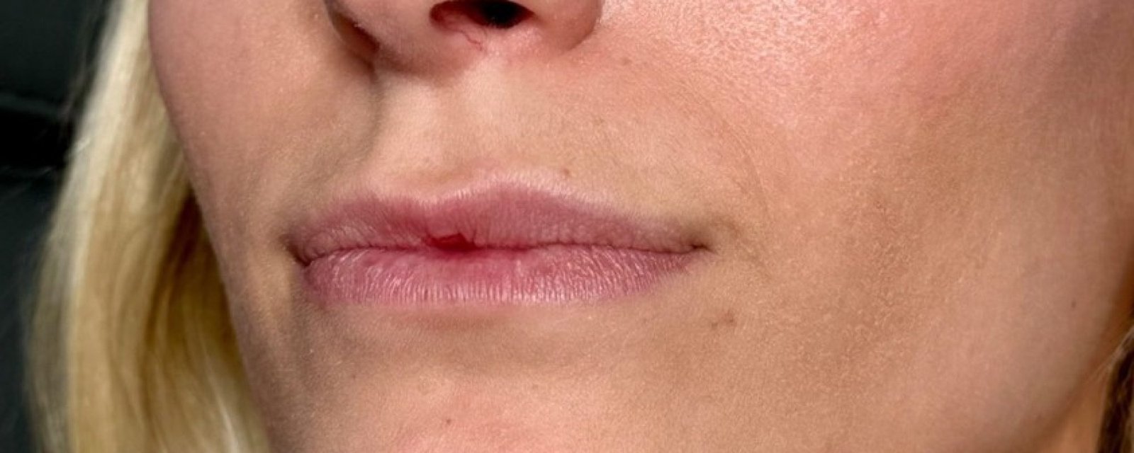 Before Dermal Filler